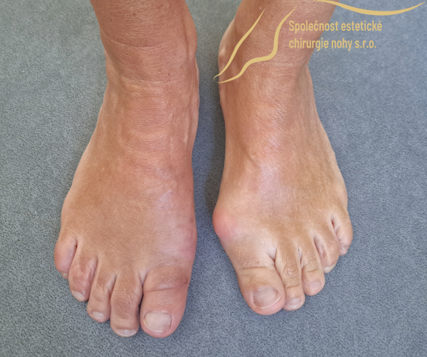 pooperačná fotka vbočeného palca pravej nohy 12 týždňov po operácii